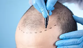 vucut-kili-sac-ekimi